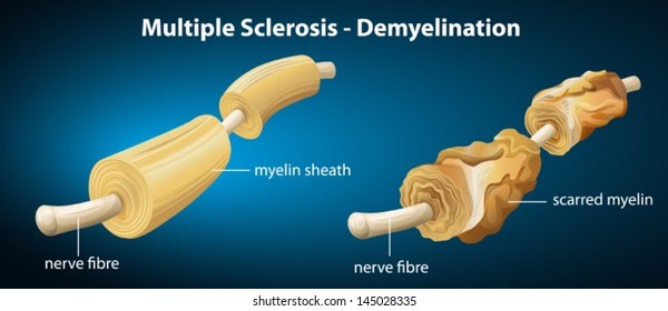 Illustration Showing The Multiple Sclerosis