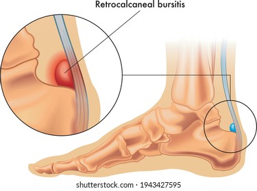 Illustration showing the position of the normal retrocalcaneal bursa in the foot, and in enlarged detail a retrocalcaneal bursitis, annotated on white.