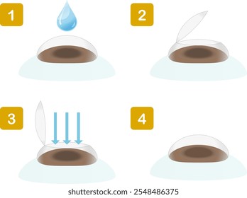 Illustration showing the procedure for vision correction surgery