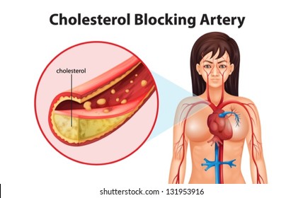 Illustration showing the process of ateriosclerosis