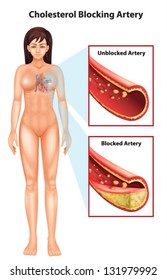 Illustration showing the process of ateriosclerosis