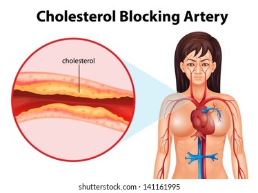 Illustration showing the process of ateriosclerosis
