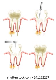 Illustration showing a root canal procedure