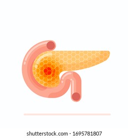 Illustration showing sick human pancreas, concept of human pancreatitis and cancer, flat design vector illustration