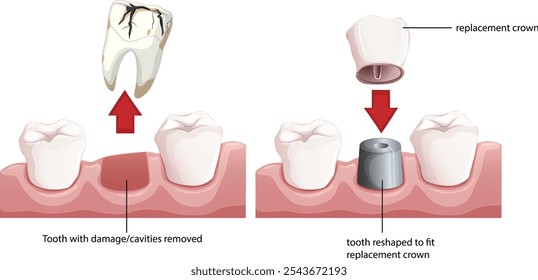 Illustration showing steps for dental crown replacement