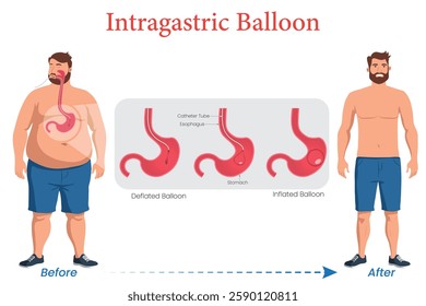 An illustration shows a diagram of an intragastric balloon inserted into a man's stomach, helping with weight loss by limiting food intake for obesity treatment.