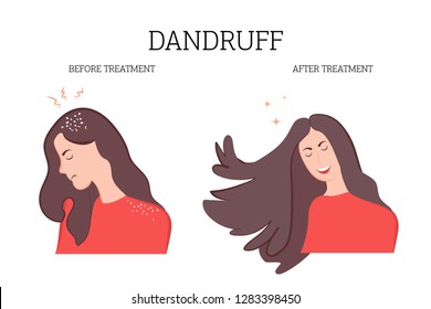 The illustration shows the girl's dandruff and beautiful hair after treatment. The patient enjoys a good result. Vector illustration for medical institutions