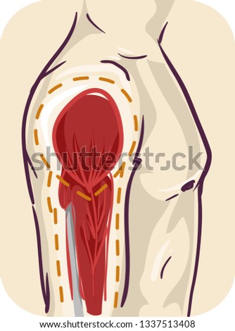 Illustration of Side of a Person Showing Shrinking Muscle. Atrophy