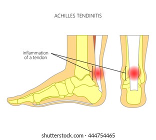 Illustration of Skeletal ankle (side view and back view) with tendinitis of Achilles tendon. Used: Gradient, transparence, blend mode.
