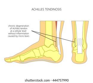 290 Achilles tendinitis Images, Stock Photos & Vectors | Shutterstock