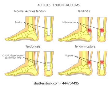 Illustration of Skeletal ankles (side view and back view) with normal and injured  Achilles tendon (tendinitis, tendinosis and torn). Used: Gradient, transparence, blend mode.