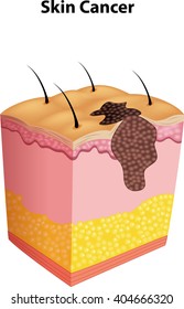 Illustration of skin cancer
