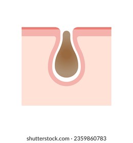 Illustration of skin care , skin cleaning (cross section of skin) | dirt in pores