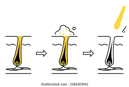 Illustration of skin care, image of pores cleaned and keratin plugs removed