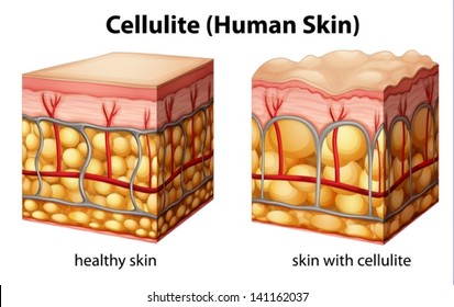 Illustration Of Skin Cross Section Showing Cellulite