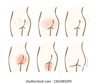 Illustration of skin problems of hips
