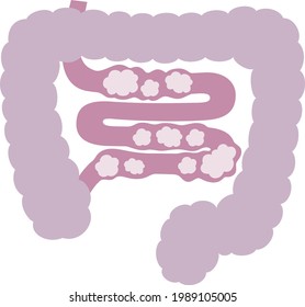 Illustration Of The Small Intestine With An Imbalance Of Bacteria. The Small Intestine Is Bloated.