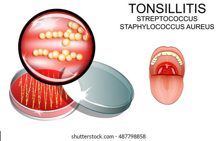 illustration of sore throat. strep. the causative agent of the infection. bacterial seeding.

