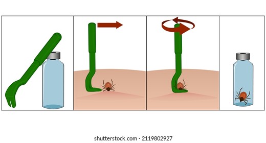 Illustration of special tweezers for removing ticks. Instructions for removing a tick with special tweezers. Tick ​​bite. Placing the tick in a container. Vector illustration