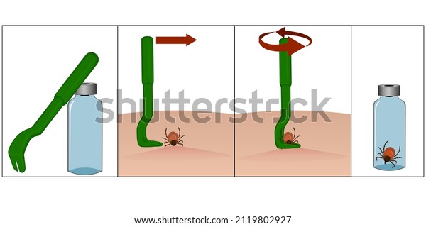 Illustration of special\
tweezers for removing ticks. Instructions for removing a tick with\
special tweezers. Tick ​​bite. Placing the tick in a container.\
Vector\
illustration
