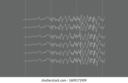 Illustration of spike epileptic seizure brain waves on black background. Vector illustration