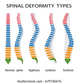 Illustration Of Spinal Deformity Types. Kyphosis, Lordosis And Scoliosis.