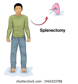 Illustration of Splenectomy in humans: removal of spleen using surgical procedure, cancer treatment. lymphoma. 