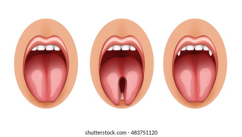 Illustration Of A Split Tongue And Fangs Graft
