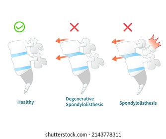 Illustration of  the Spondylolisthesis Symptoms