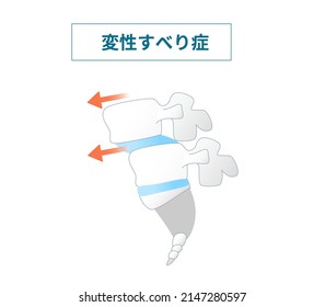 Illustration of  the Spondylolisthesis Symptoms Translation: How Degenerative Spondylolisthesis Works