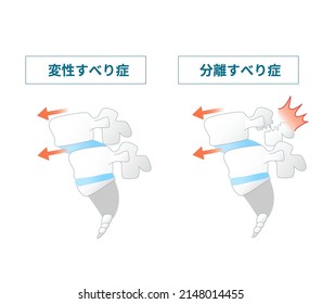 Illustration of  the Spondylolisthesis Symptoms Translation: How Separation Spondylolisthesis and Degenerative Spondylolisthesis Work