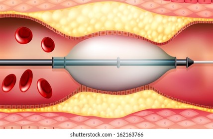 Illustration of a Stent