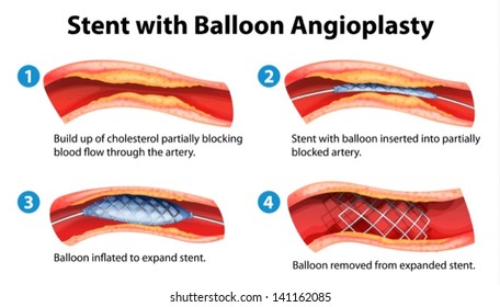 Illustration of stent angioplasty procedure