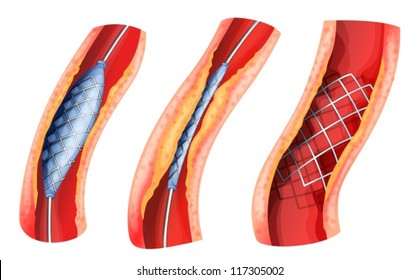 Illustration of a stent used to open blocked artery on a white background