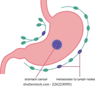 Illustration of stomach cancer that has moved to the lymph nodes
