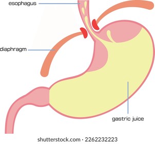 Illustration of stomach causing reflux esophagitis