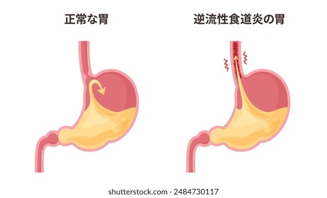 Illustration of a stomach with gastroesophageal reflux and gastric acid_Translation: Normal stomach, stomach with gastroesophageal reflux