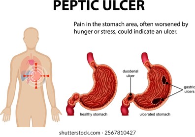 Illustration of stomach ulcers and related symptoms