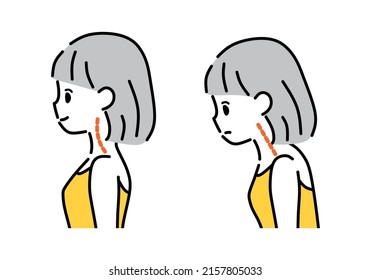 Illustration of a straight neck and a normal neck.