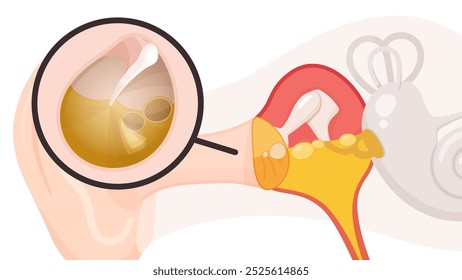 Ilustración de la estructura del oído y la otitis media serosa del tímpano