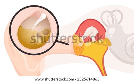 Illustration of the structure of the ear and the eardrum_serous otitis media