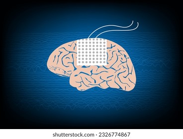 Illustration of subdural electrode over brain surface for EEG or brain waves monitoring in epilepsy surgery.