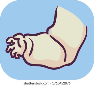 Illustration Of Swollen Arm Symptom Of Edema