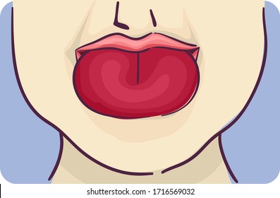 Illustration of a Swollen Tongue Symptom