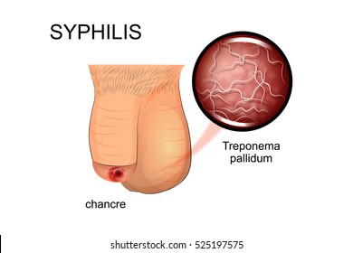 syphilis chancre