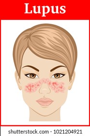 Illustration Symptoms Of Systemic Lupus On The Face Of A Young Girl