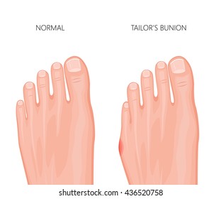Illustration of the tailor's bunion of the human foot. Used: gradient, transparency; blend mode.