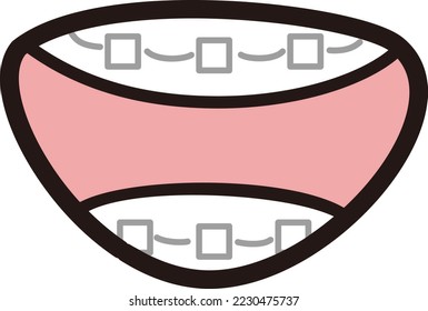 Illustration of teeth with braces