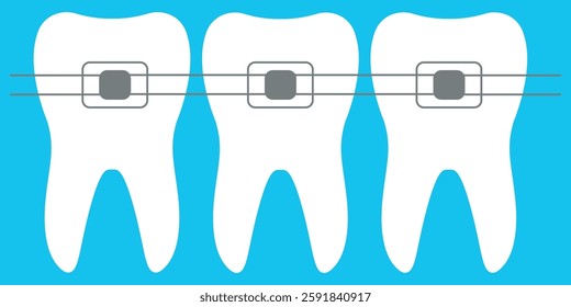 Ilustração de Dentes com Chaves para Tratamento Ortodôntico em Fundo Azul. Ilustração digital mostrando dentes com aparelho em um fundo azul, representando ortodônticos, cuidados dentários