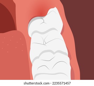 Illustration of teeth row with inflamed gum over the growing wisdom tooth. Vector illustration